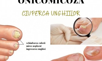 Onicomicoza (ciuperca unghiei)